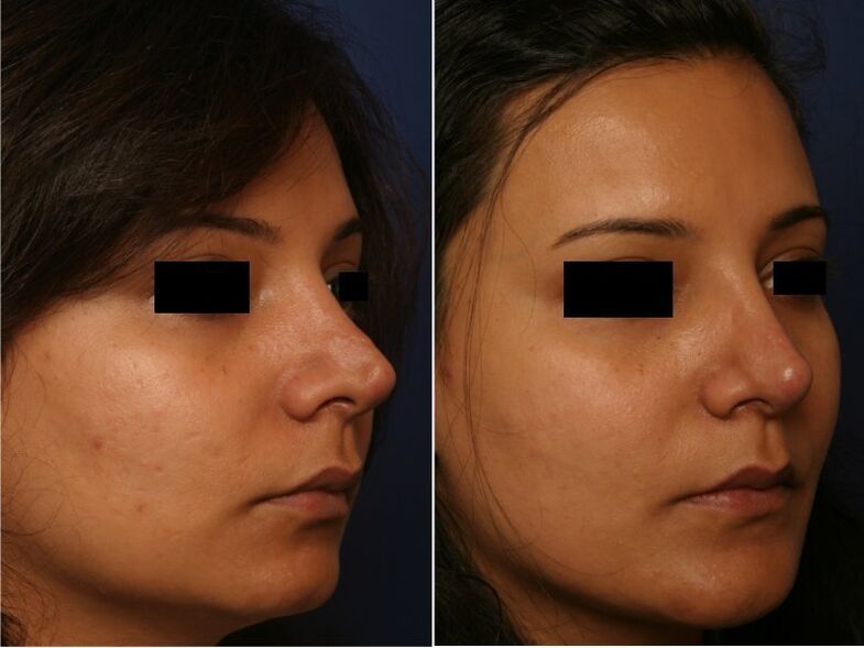 plasztikai műtét eredménye