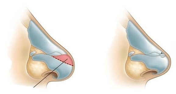 Az orr alakjának korrekciója
