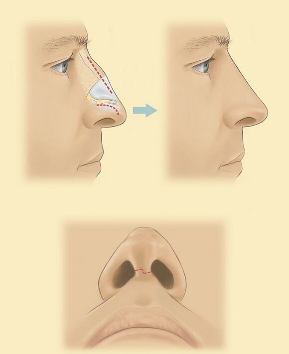 az orr orrplasztikájának sémája