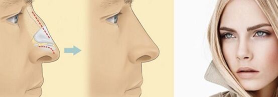 az orr alakjának korrekciója nem sebészeti orrplasztikával