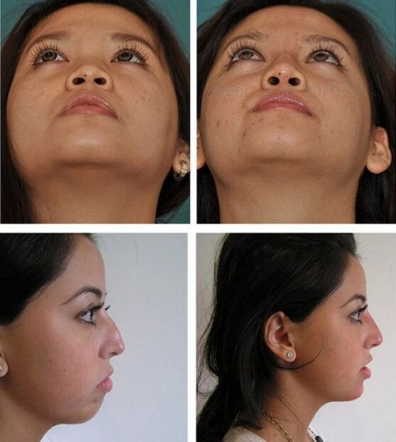 fotók az orrplasztika előtt és után műtét nélkül