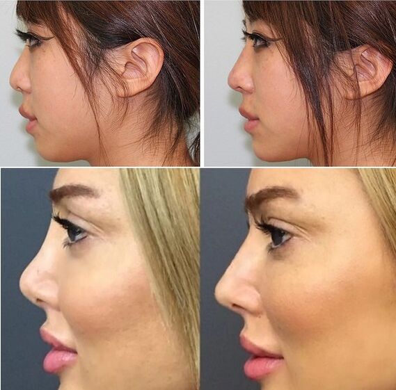 fényképek a műtét nélküli orrplasztika előtt és után