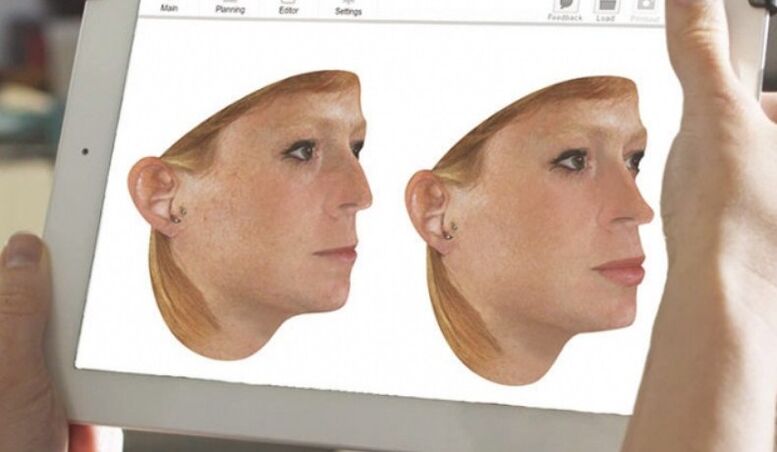 Az orr számítógépes modellezésének módszere orrplasztika előtt