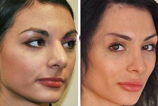 orr plasztikai műtét előtt és után