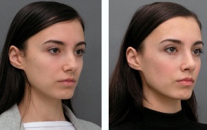A lány előtt, illetve után orr orrplasztika
